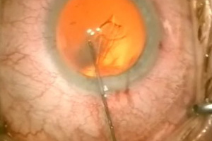 Grauer Star – Augenärztliche Gemeinschaftspraxis | Dr. Heuring, Dr. Jung & Kollegen