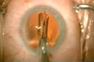 Grauer Star – Augenärztliche Gemeinschaftspraxis | Dr. Heuring, Dr. Jung & Kollegen