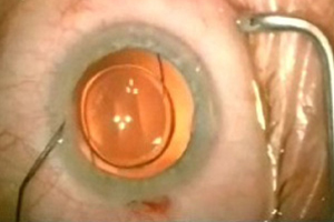 Grauer Star – Augenärztliche Gemeinschaftspraxis | Dr. Heuring, Dr. Jung & Kollegen