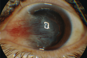 Flügelfell der Bindehaut – Augenärztliche Gemeinschaftspraxis | Dr. Heuring, Dr. Jung & Kollegen