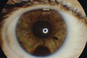 Leberfleck der Regenbogenhaut  – Augenärztliche Gemeinschaftspraxis | Dr. Heuring, Dr. Jung & Kollegen