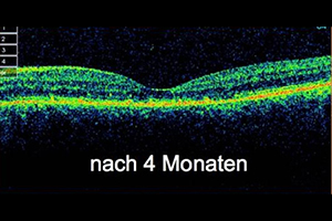 Venöser Gefäßverschluss – Augenärztliche Gemeinschaftspraxis | Dr. Heuring, Dr. Jung & Kollegen