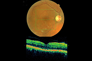 Venöser Gefäßverschluss – Augenärztliche Gemeinschaftspraxis | Dr. Heuring, Dr. Jung & Kollegen