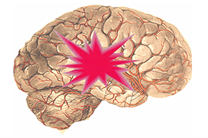 Schlaganfallprophylaxe – Augenärztliche Gemeinschaftspraxis | Dr. Heuring, Dr. Jung & Kollegen