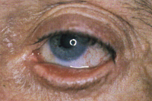 Auswärtskehrung – Augenärztliche Gemeinschaftspraxis | Dr. Heuring, Dr. Jung & Kollegen