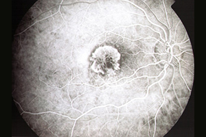 Fluoreszeinangiographie – Augenärztliche Gemeinschaftspraxis | Dr. Heuring, Dr. Jung & Kollegen