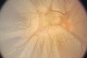 Netzhautablösung – Augenärztliche Gemeinschaftspraxis | Dr. Heuring, Dr. Jung & Kollegen