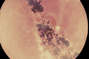 Netzhautlöcher – Augenärztliche Gemeinschaftspraxis | Dr. Heuring, Dr. Jung & Kollegen