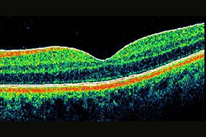 OCT – Augenärztliche Gemeinschaftspraxis | Dr. Heuring, Dr. Jung & Kollegen