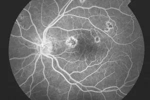 Nicht Proliferative Retinopathie – Augenärztliche Gemeinschaftspraxis | Dr. Heuring, Dr. Jung & Kollegen
