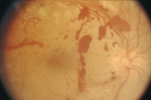 Proliferative Retinopathie – Augenärztliche Gemeinschaftspraxis | Dr. Heuring, Dr. Jung & Kollegen