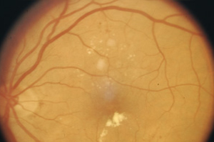 Proliferative Retinopathie – Augenärztliche Gemeinschaftspraxis | Dr. Heuring, Dr. Jung & Kollegen